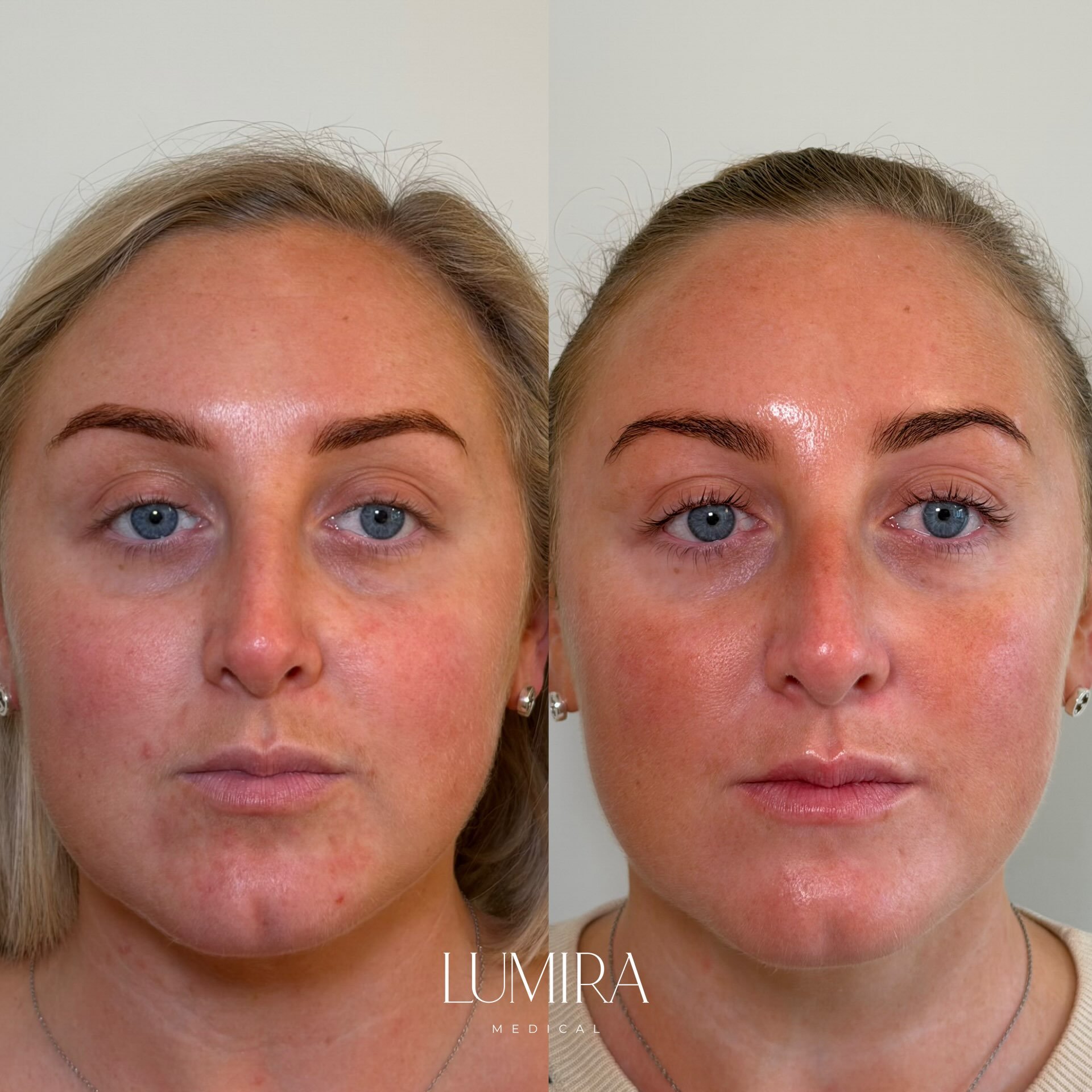 And this is why you need @teoxane_uk babyGLOW&trade;️ ✨

If your skin is feeling dull, dehydrated or lacklustre, this is one of my favourite treatments. 

Redensity 1 is an injectable skin booster made up of hyaluronic acid, along with a unique blend