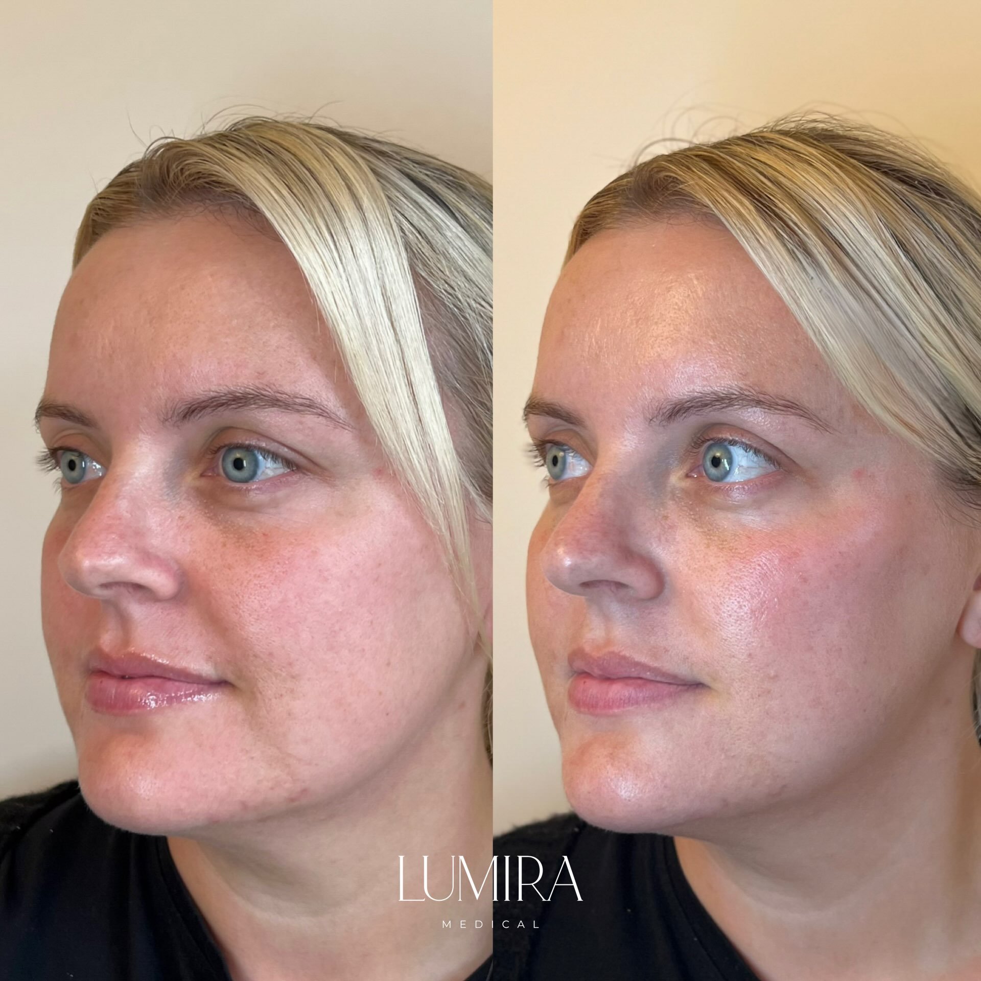 This is why cheek filler will always be one of my favourite treatments. 

This client came to me following a weight loss journey in the lead-up to her wedding. She felt amazing in her body but noticed that the change in her face had left her feeling 