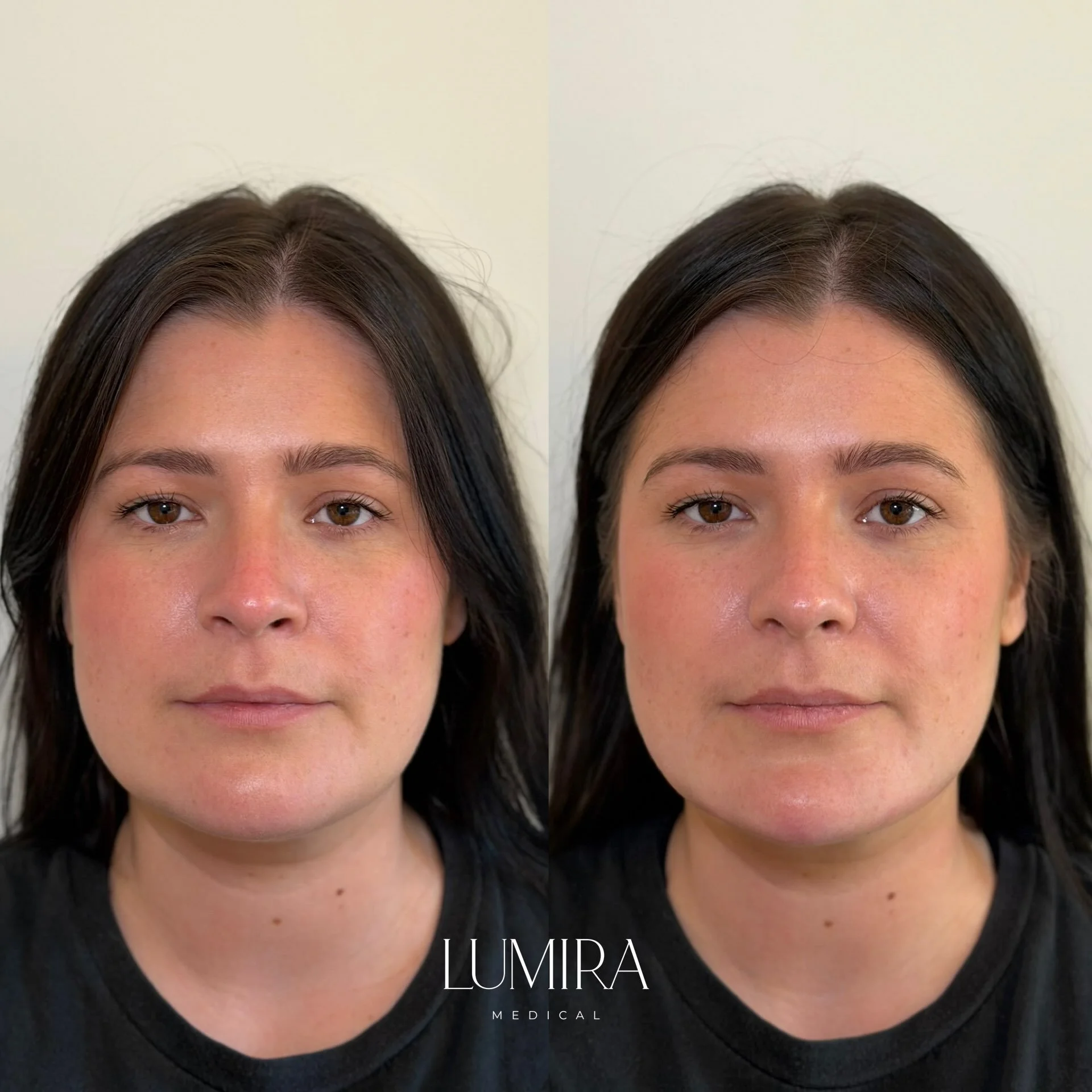 One of the most impactful treatments in my aesthetic toolbox 🤍

Adding subtle structure can have a really noticeable effect on the overall balance and proportions of the face. 

For this patient, the aim was to create more definition to the lower fa