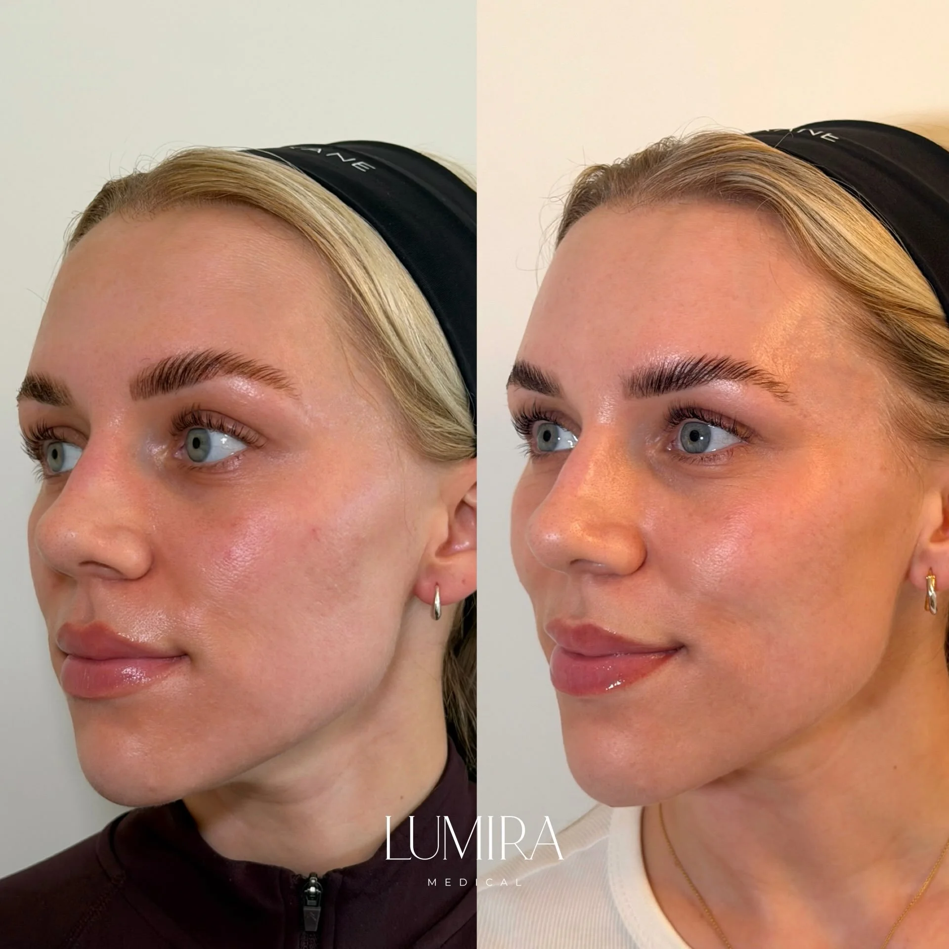 I think I&rsquo;ve finally found a skin booster that I&rsquo;ve fallen in love with 🤍

Here&rsquo;s my own before and 1 month after my initial course of @teoxane_uk babyGLOW&trade;️ 🫧

I&rsquo;ve always been a little hesitant when it comes to skin 