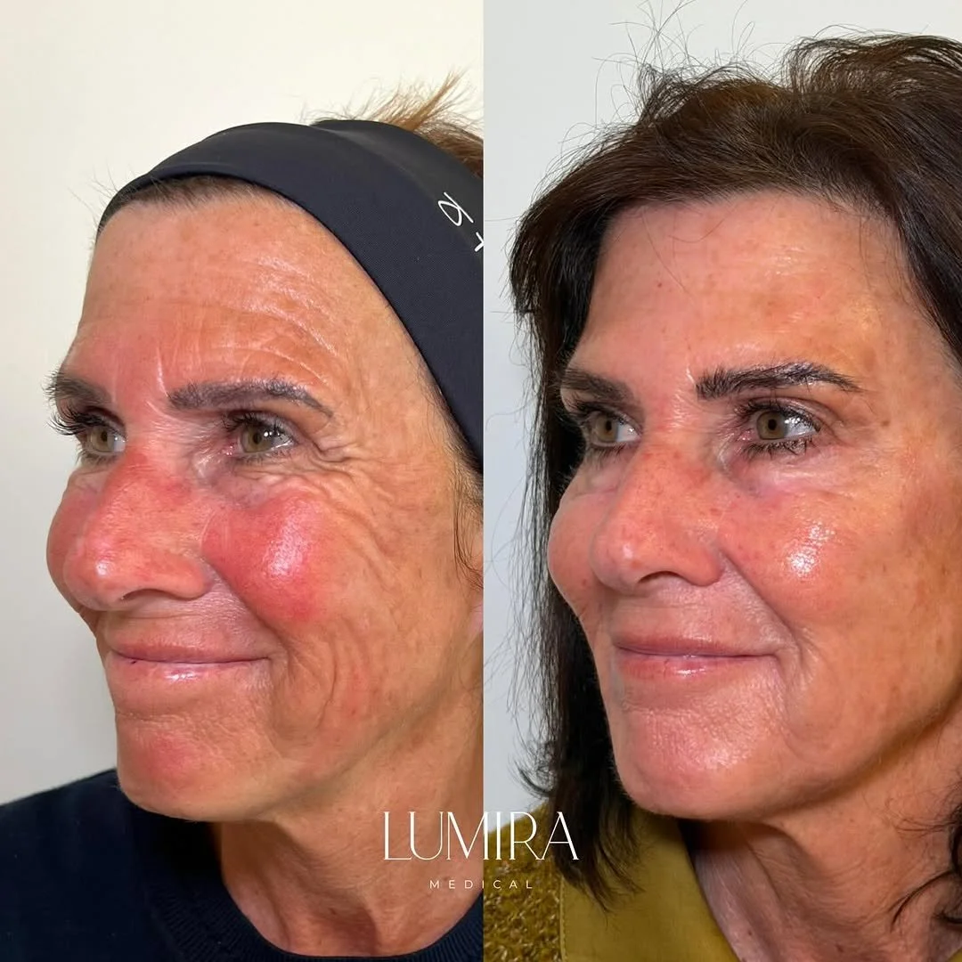 Before and after injectable treatment at Lumira Medical.