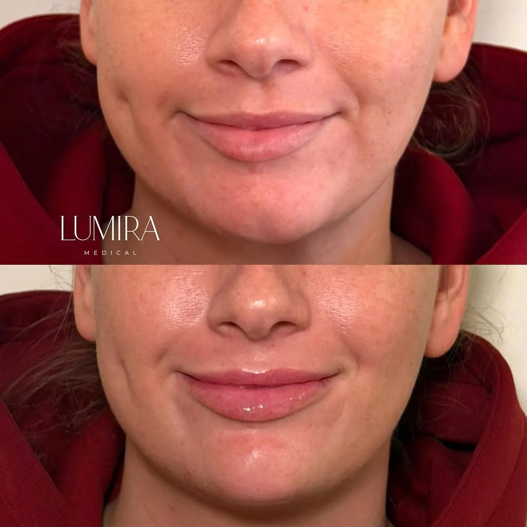 Before and after results following aesthetic treatment at Lumira Medical.