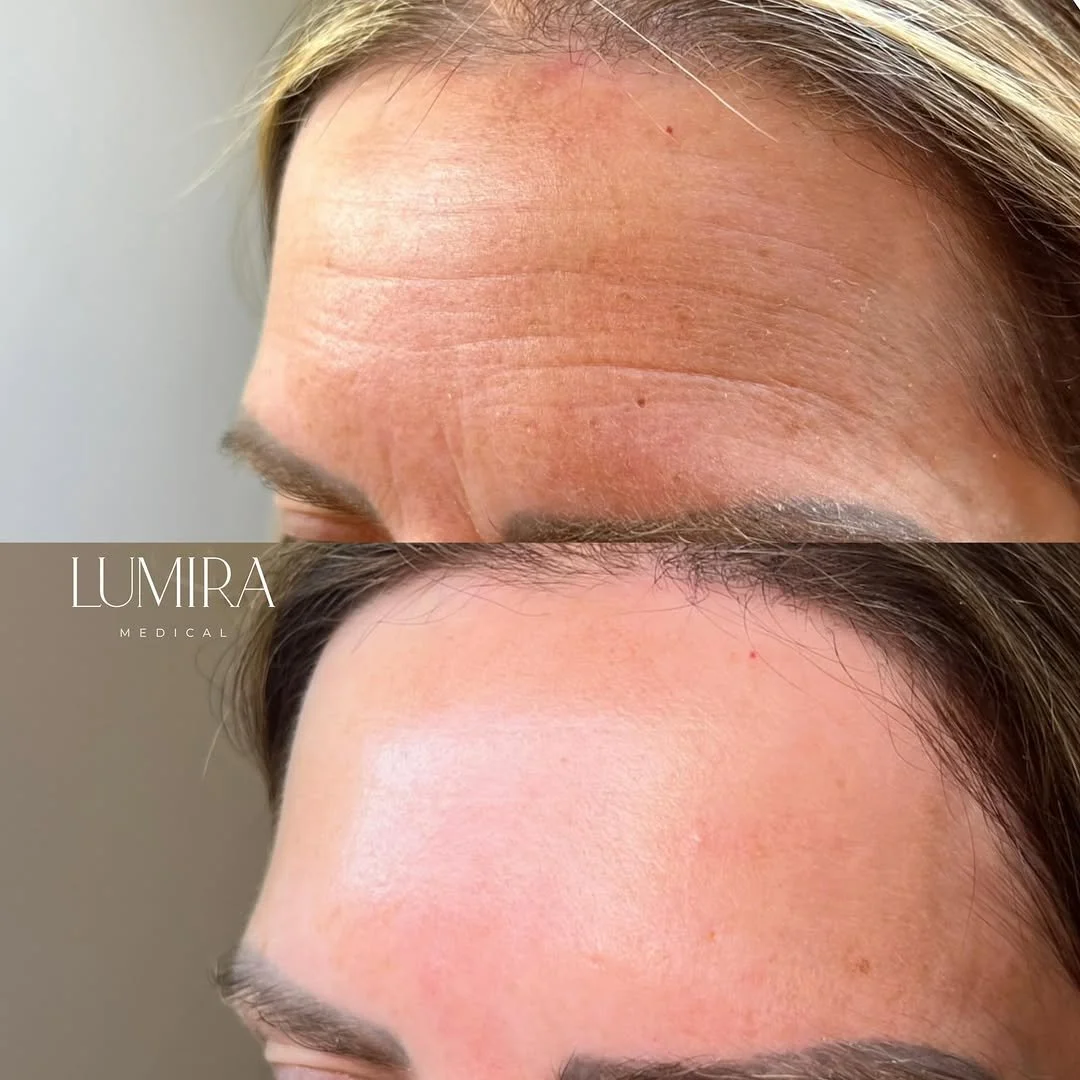 Before and after skin rejuvenation treatment at Lumira Medical.