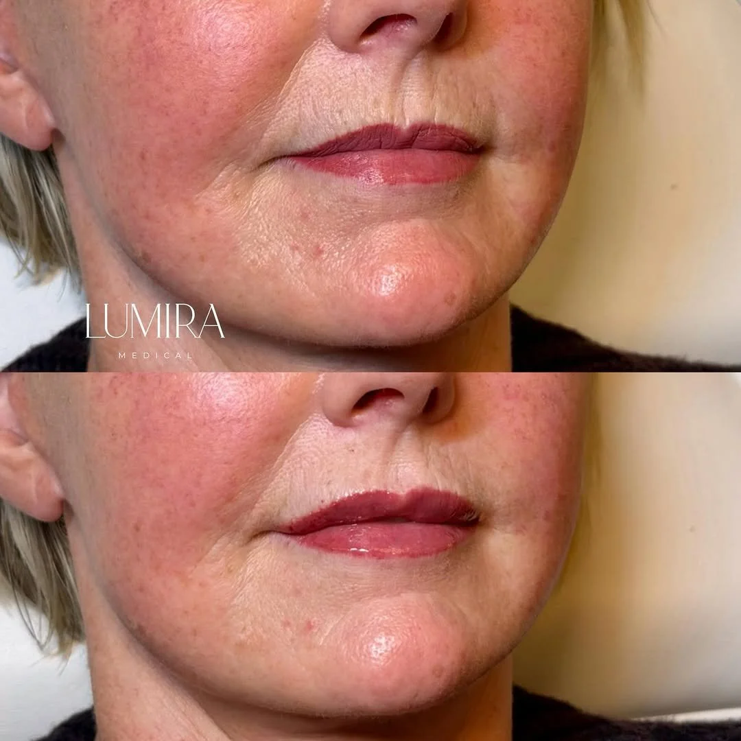 Natural aesthetic treatment results by Dr Chloe Wilson.