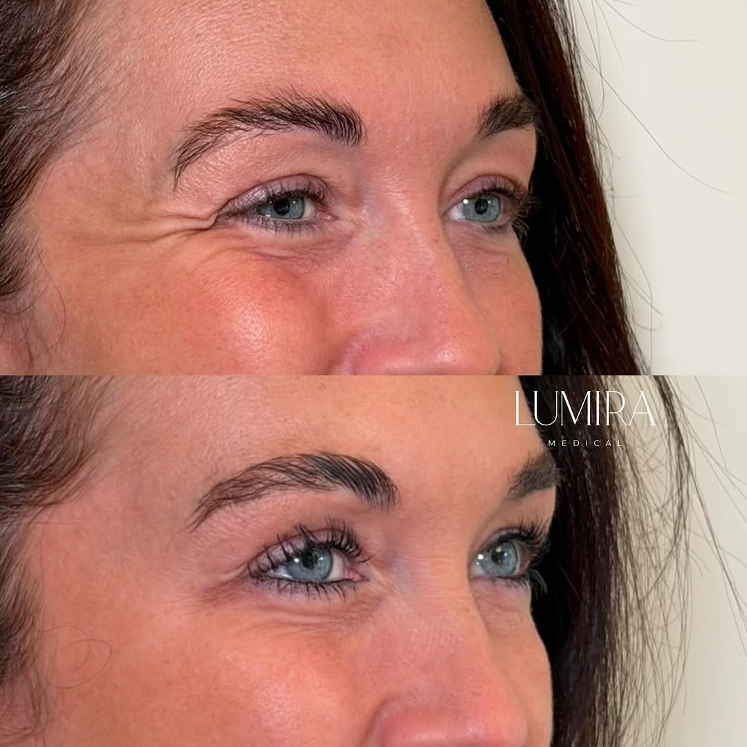 Doctor-led aesthetic treatment before and after results.