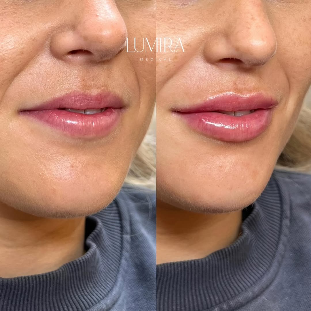 Patient results showcasing natural, refined aesthetic enhancements.