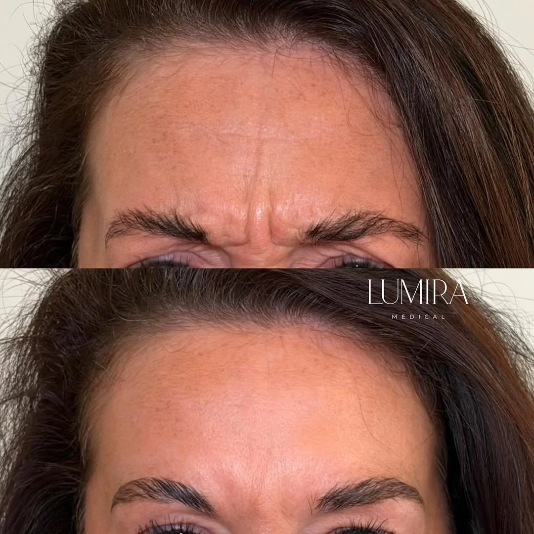 Before and after facial rejuvenation treatment by Lumira Medical.