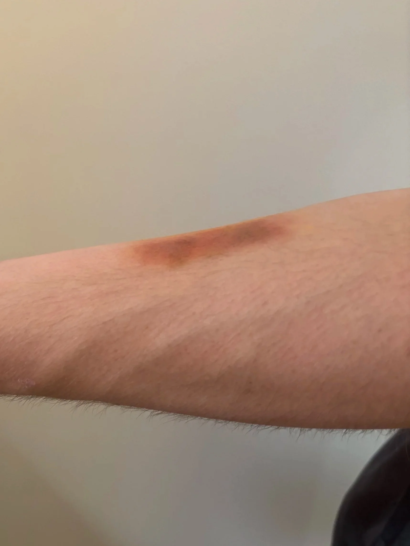 AFTER: Basic FX - Bruise