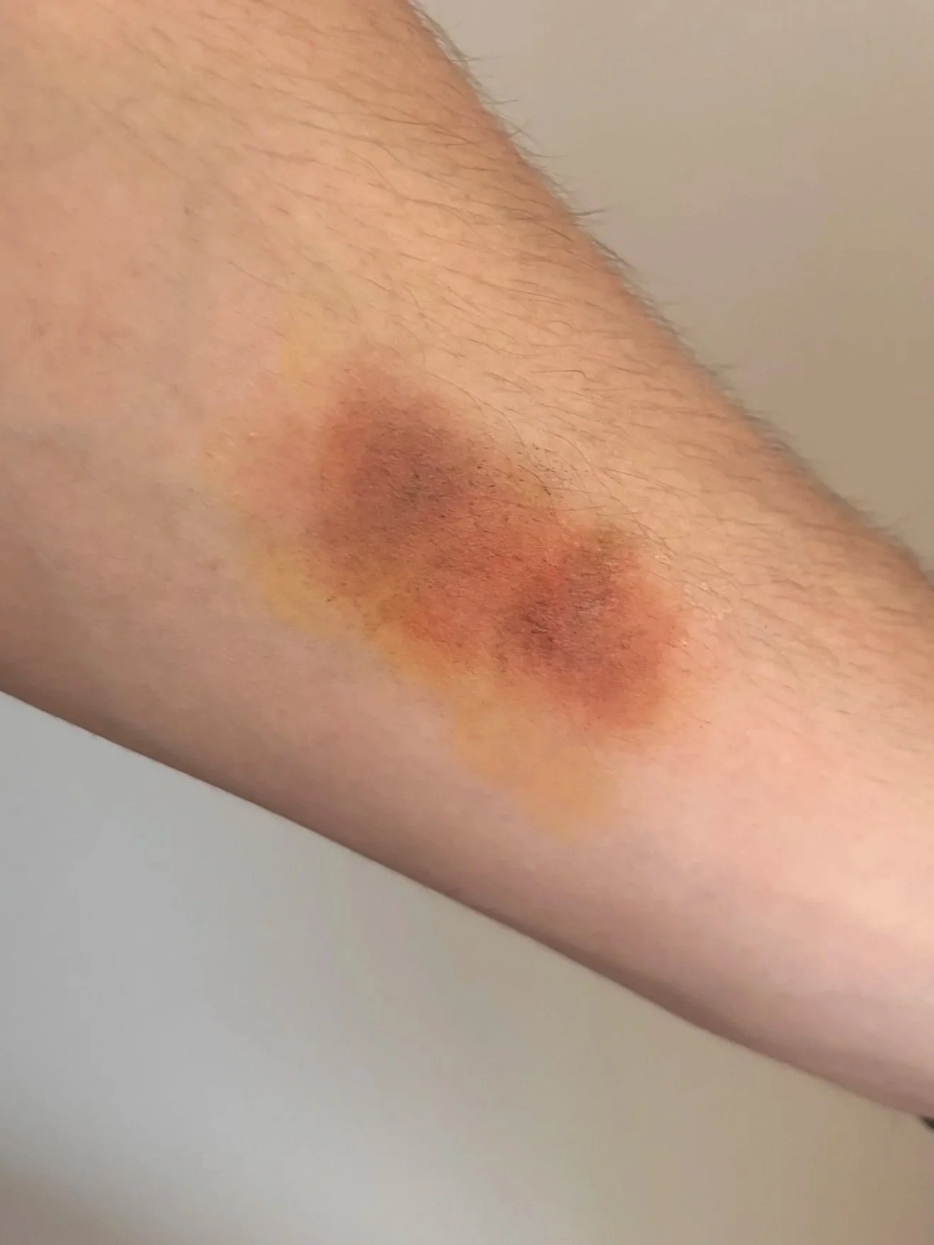 AFTER: Basic FX - Bruise