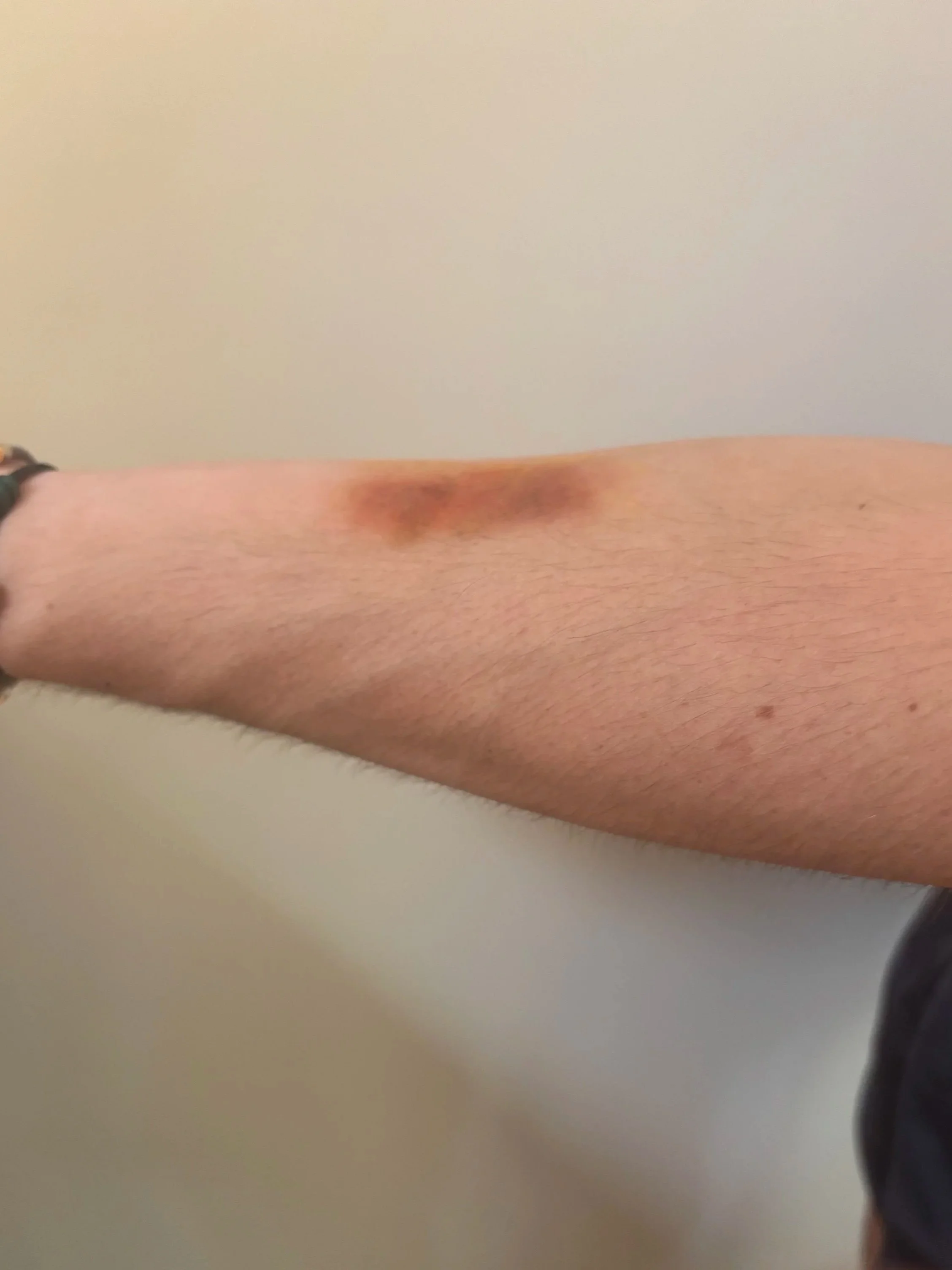 AFTER: Basic FX - Bruise