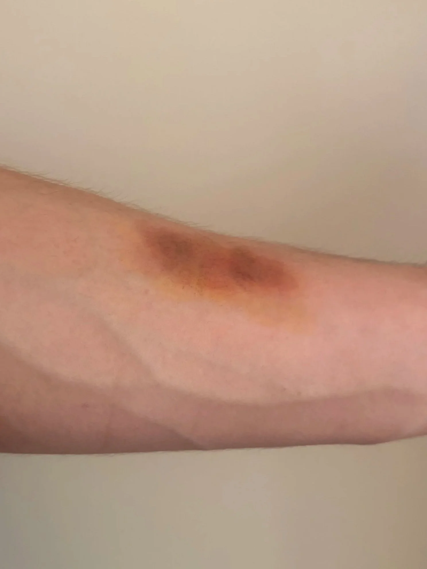 AFTER: Basic FX - Bruise