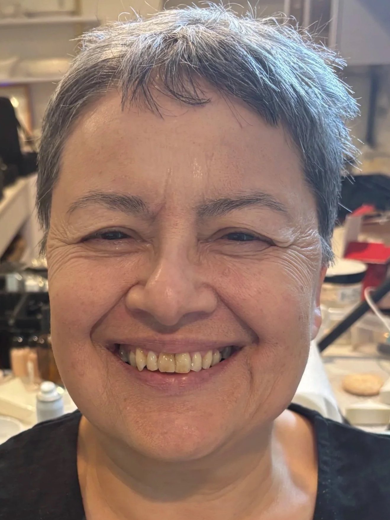 AFTER / FRONT: Aging - Stretch/Stipple - Age 55 to 65
