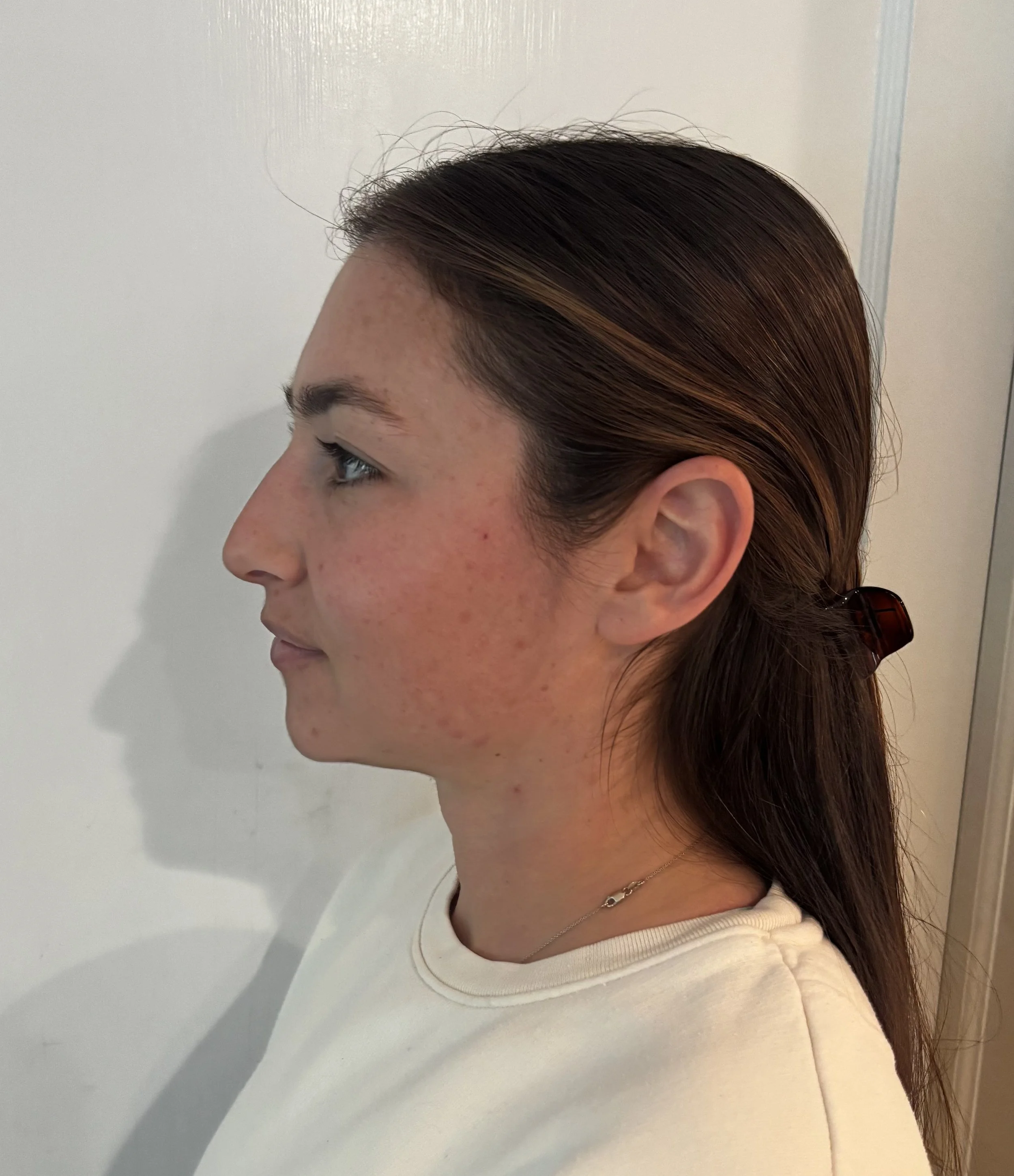 BEFORE: Straight & Corrective - Look 1