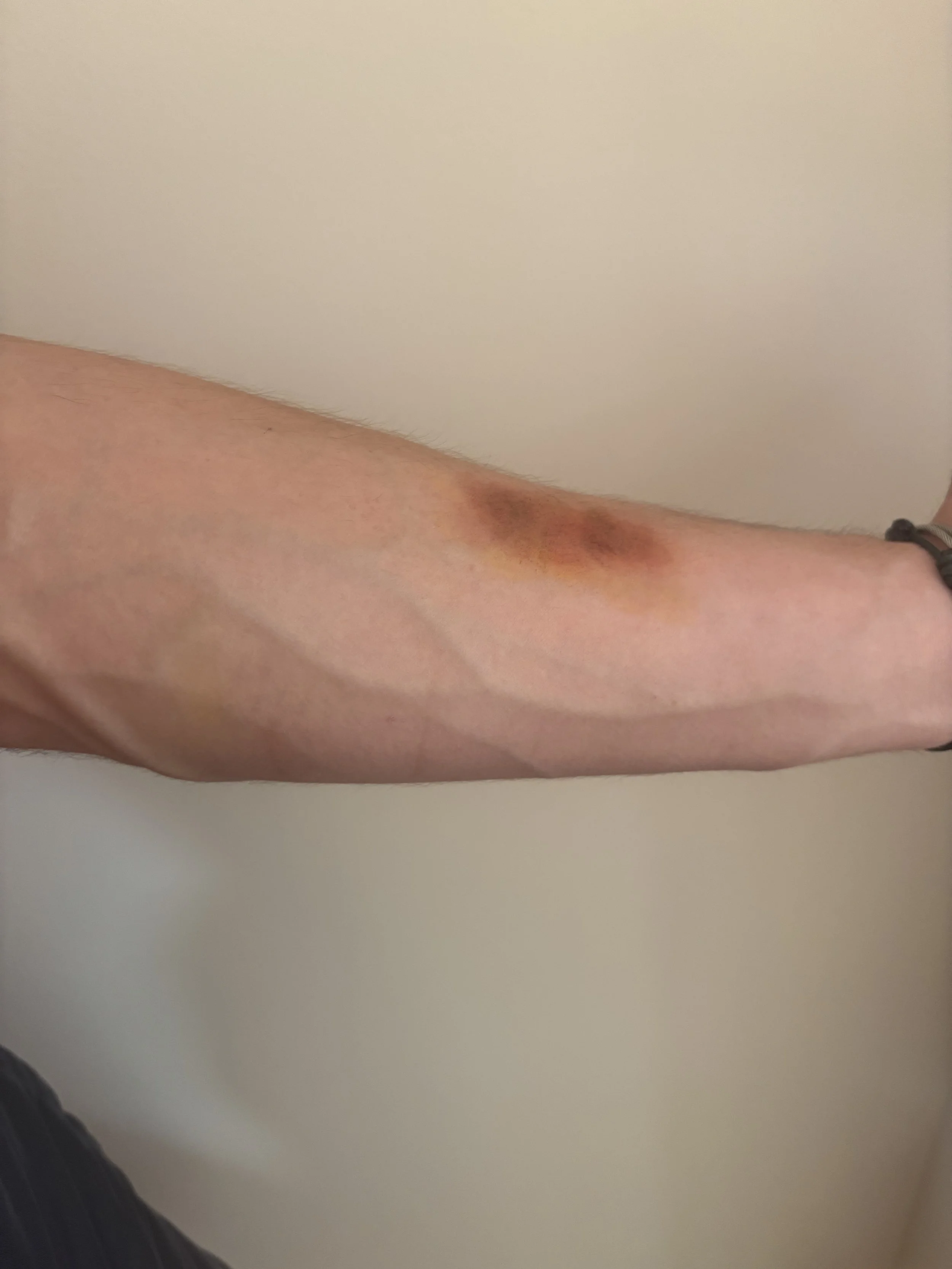 AFTER: Basic FX - Bruise
