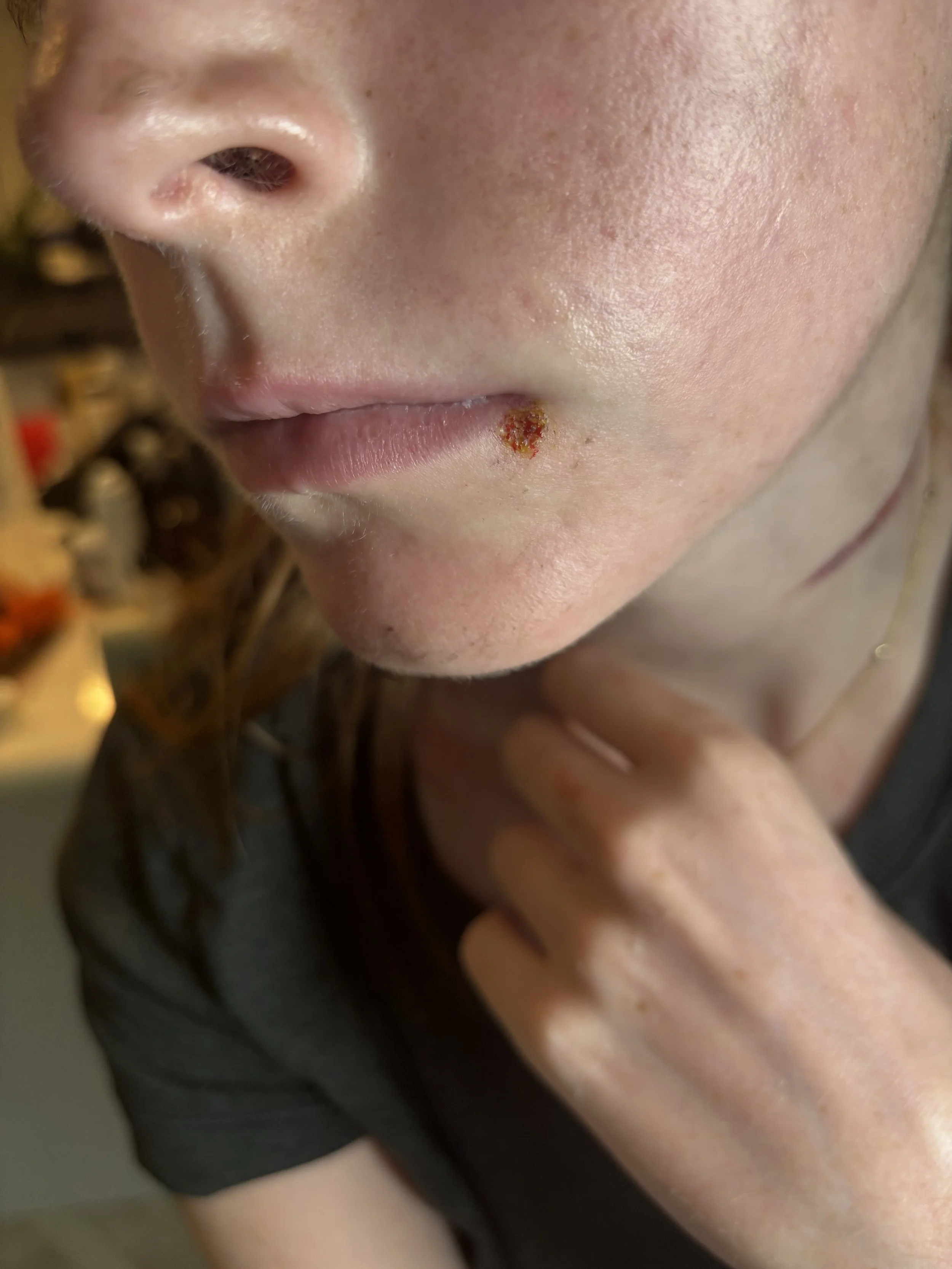 AFTER: Basic FX - Scab