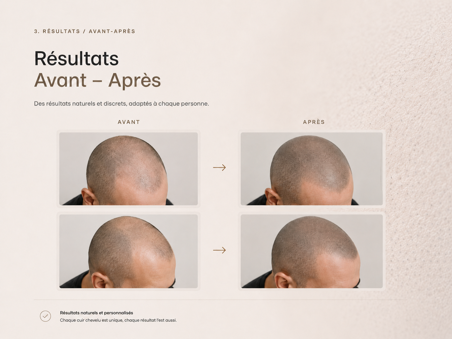avant aprés tricopigmentation.png