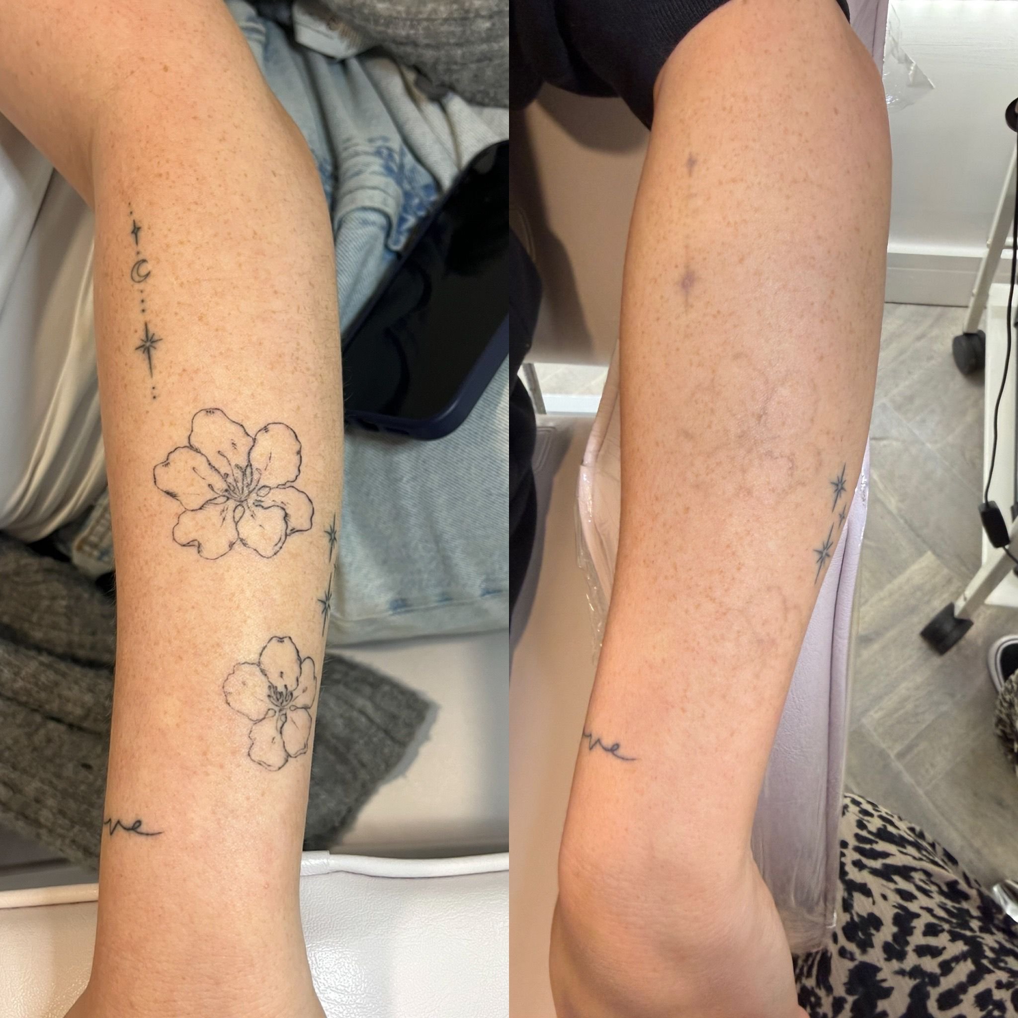 Close-up of two legs with tattoos, one tattoo features a flower and one features a moon and stars, in a medical or clinical setting.