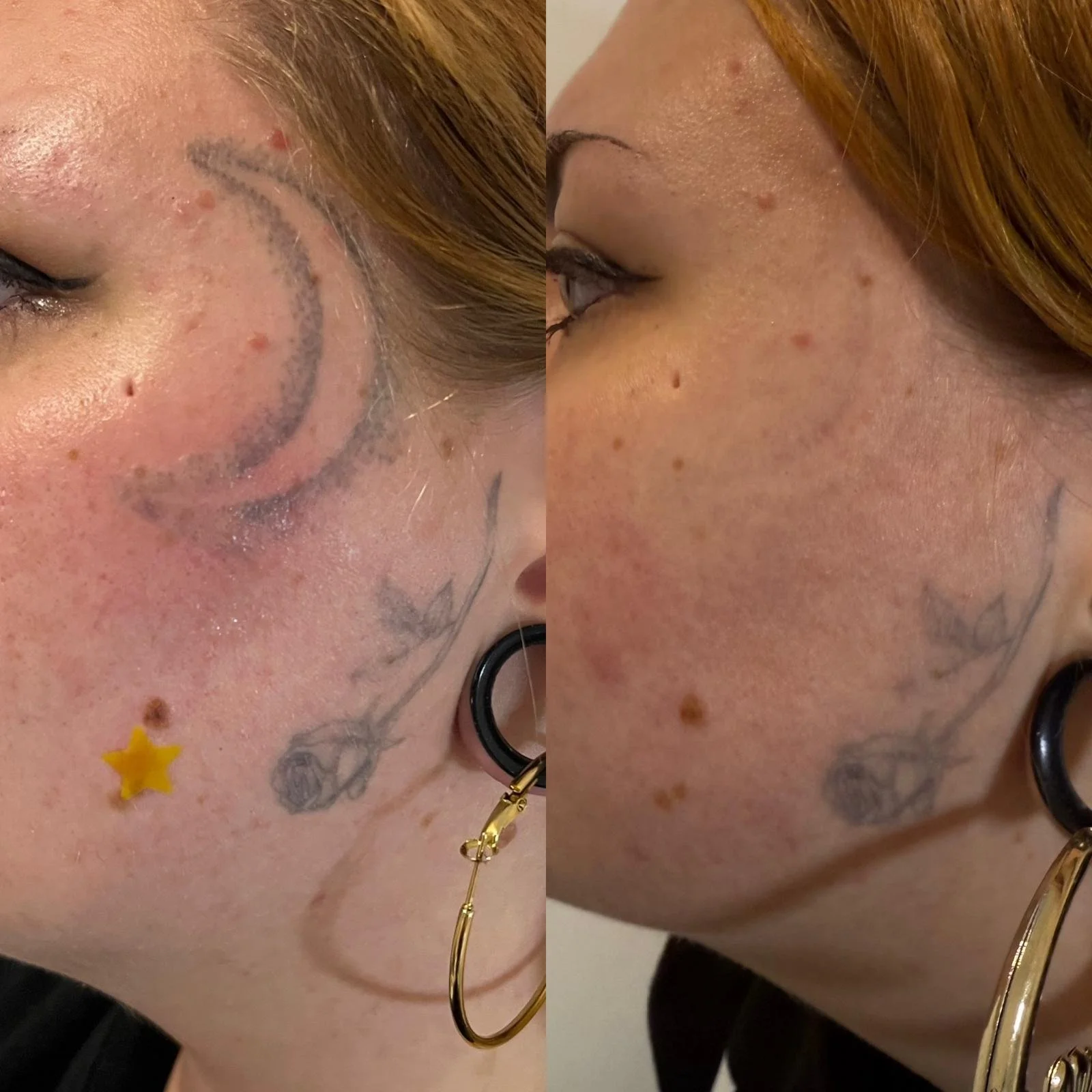 Close-up of a person's face showing skin imperfections, tattoos, and colorful eye makeup, with a focus on the cheek and eye area.