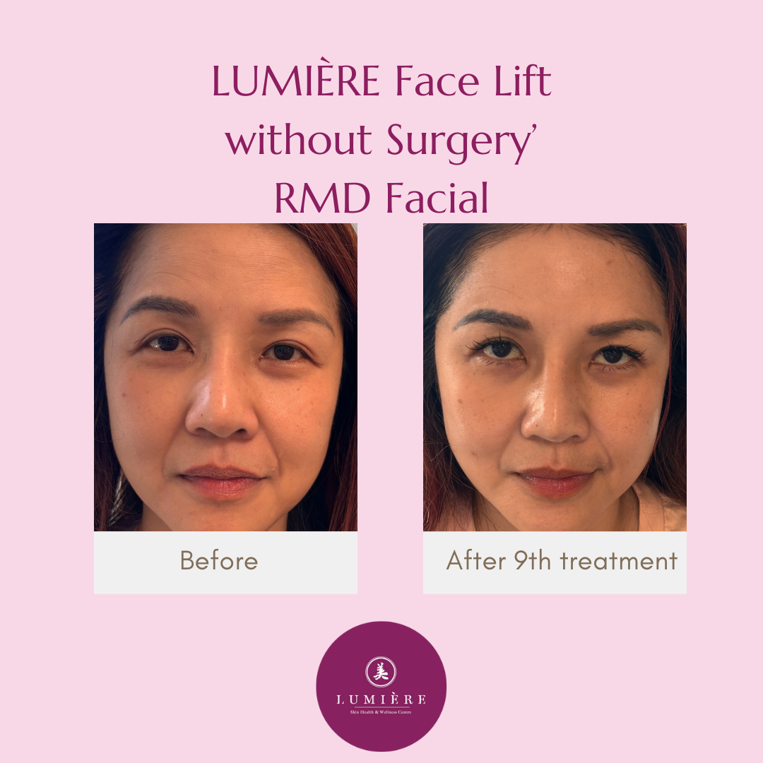Side-by-side comparison of a woman's face before and after nine treatments with the Lumière Face Lift RMD Facial procedure, showing visible skin improvements.