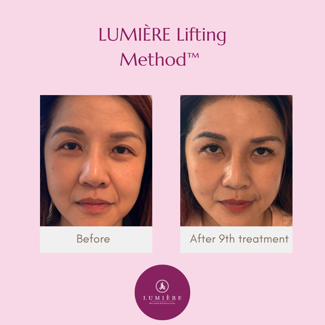 Side-by-side comparison of a woman's face before and after nine treatments with the Lumière Face Lift RMD Facial procedure, showing visible skin improvements.