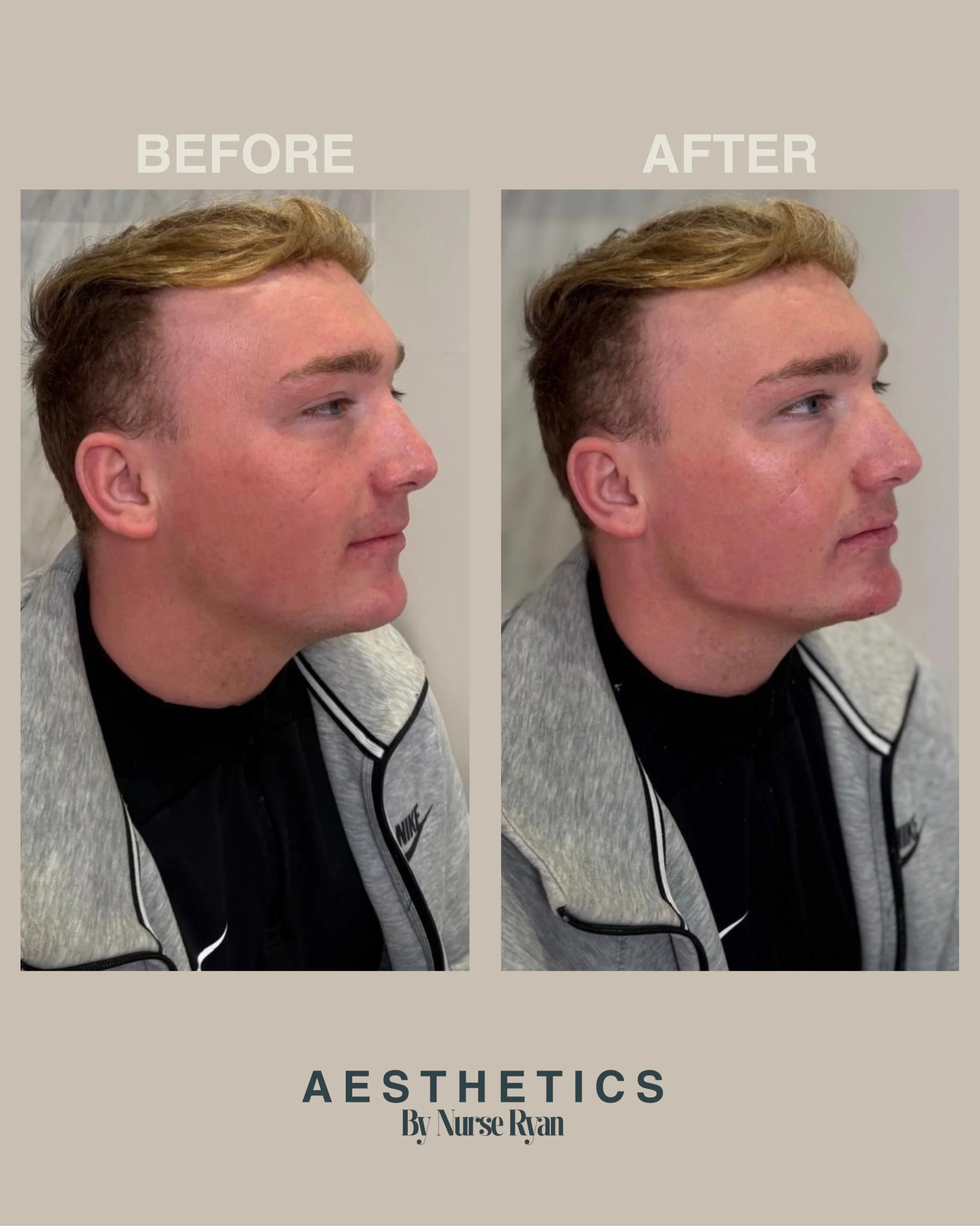 Male Lower Face Enhancement 💉

This client felt they were lacking definition and balance through the lower face.

Following consultation, we decided to strategically place dermal filler to the chin and jaw to help elongate the profile, improve struc