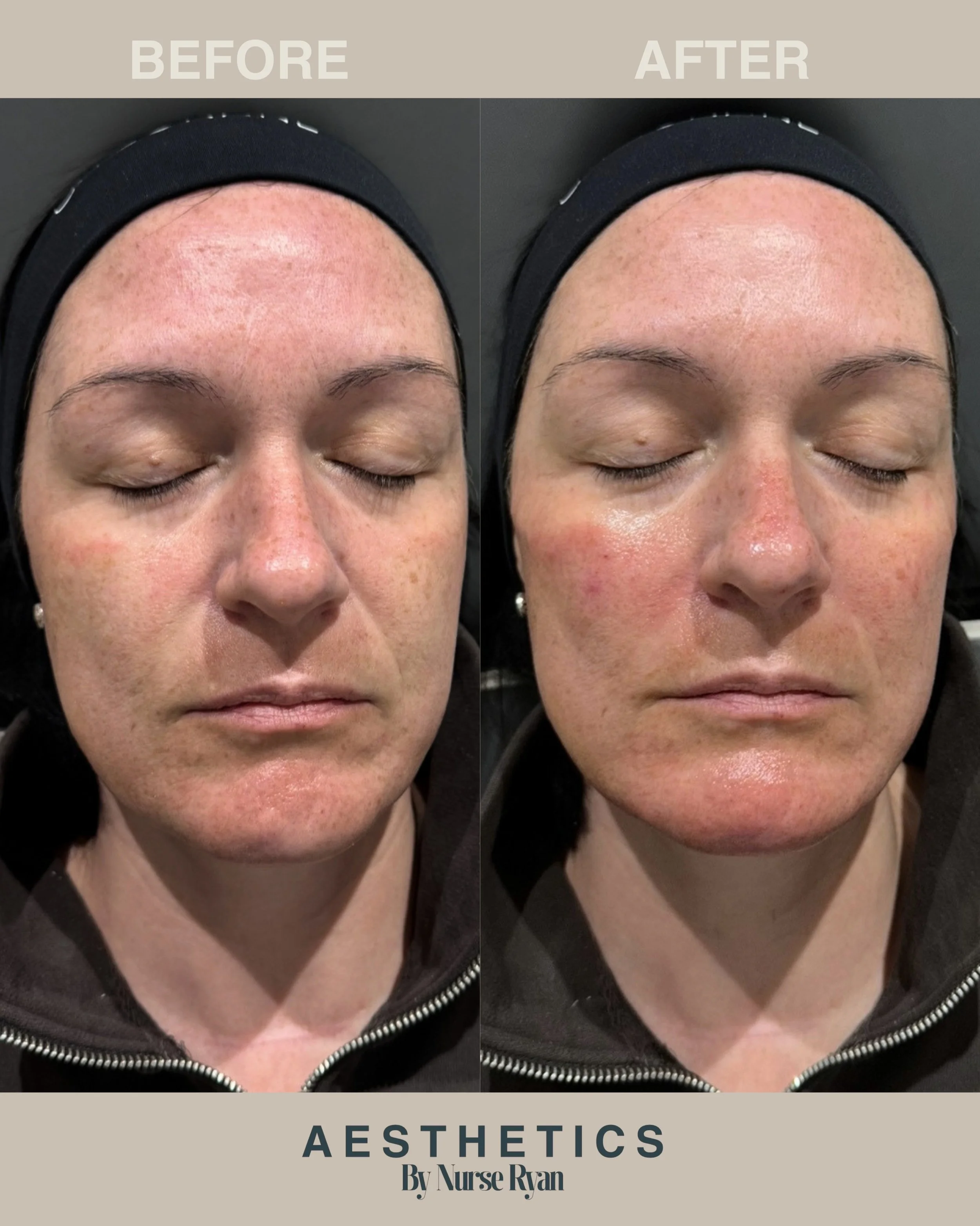 Facial Rejuvenation using 3ml Teoxane Dermal Filler 💉

This client felt due to the menopause they had started to loose volume to the mid and lower part of the face. The aim was subtle rejuvenation that wouldn&rsquo;t be noticeable.

We placed Teoxan