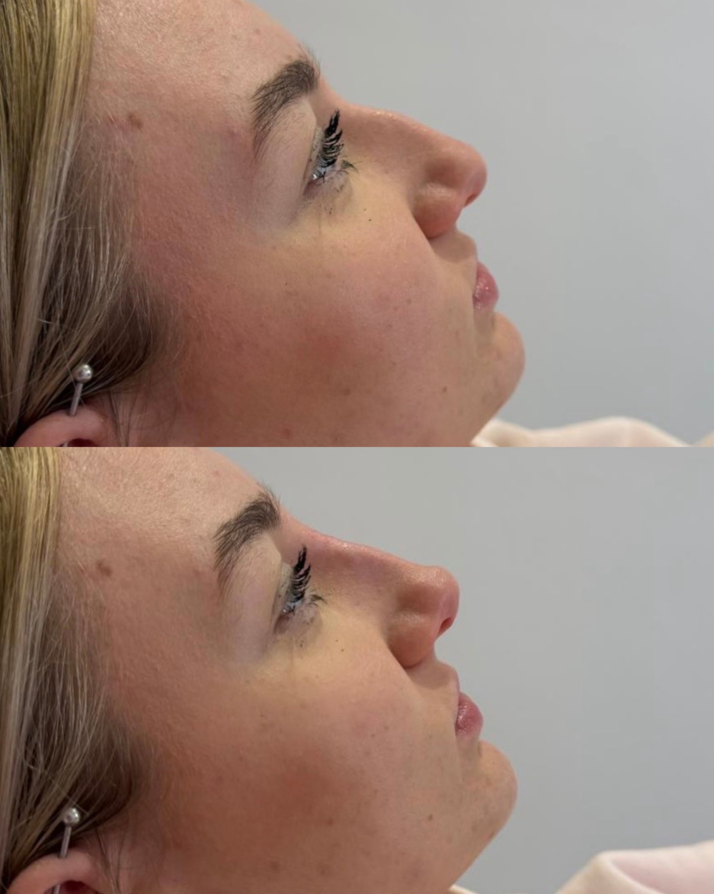 Non-surgical Rhinoplasty with Tip Lift 🤌🏼

This is a treatment I&rsquo;ve been offering for a while but have never really posted and i honestly do not know why!!!

A non-surgical rhinoplasty treatment, using dermal filler, can help to smooth bumps,