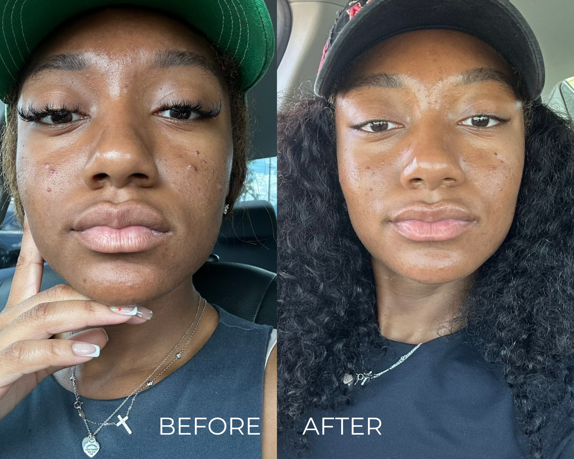 Comparison of a woman before and after a skincare treatment. In the "before" photo, she has acne and blemishes on her face, wearing a green cap and a navy top, with jewelry including necklaces and earrings. In the "after" photo, her skin appears clearer and smoother with fewer blemishes, and she is wearing a black cap and a dark sweater or top.