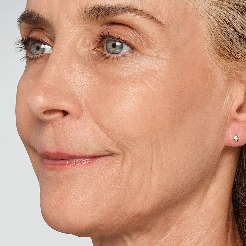 jawline-cheryl-before_igvvup.webp