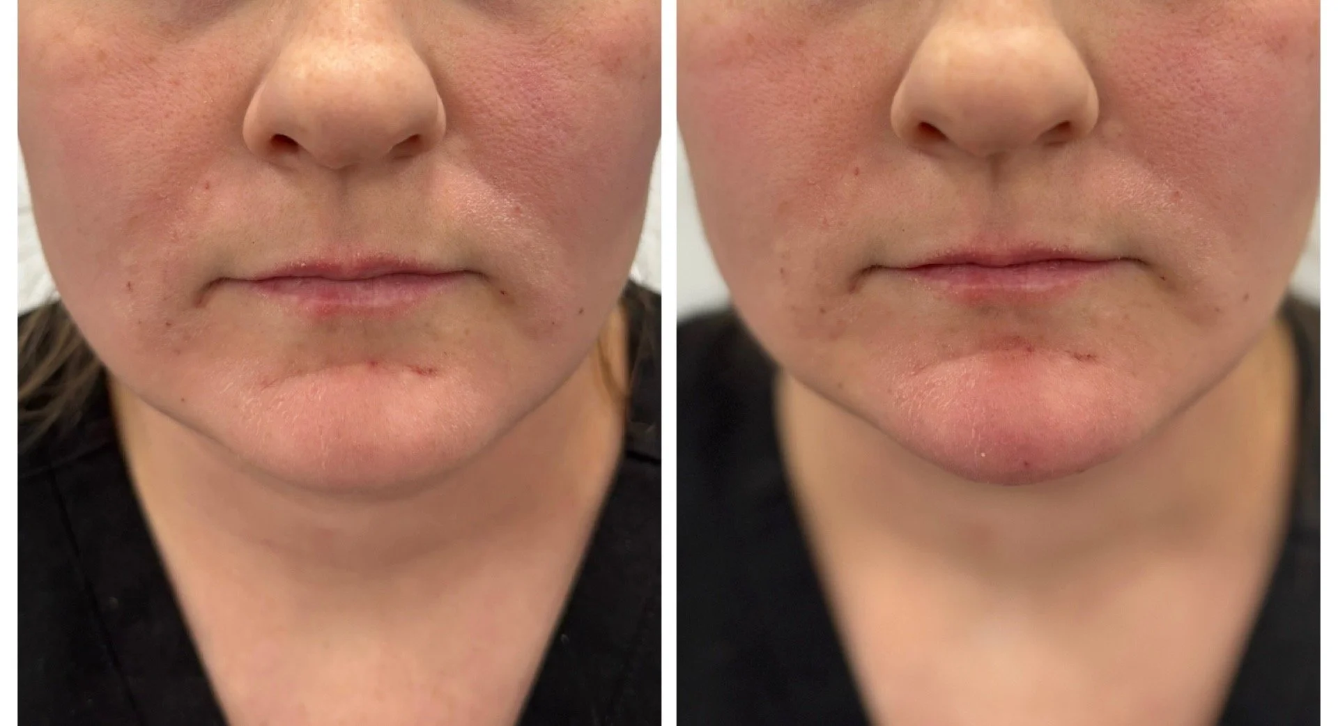 Side-by-side comparison of a person's face showing skin improvements, focusing on the area around the mouth.
