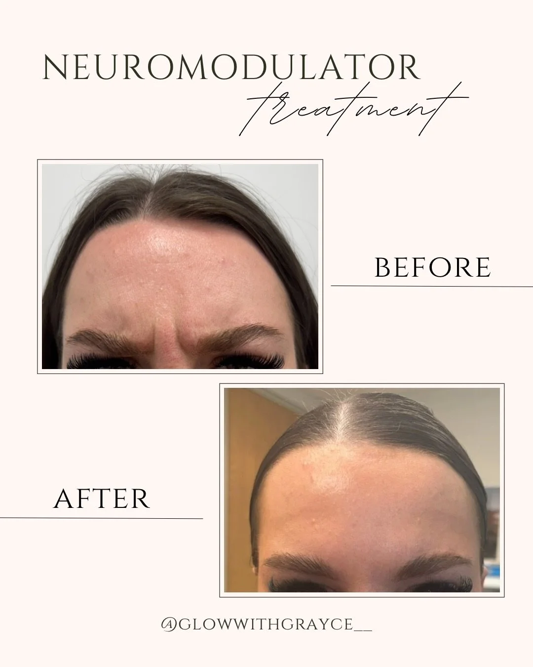 Before and after images of a woman's forehead showing the effects of a neuromodulator treatment. The "before" image shows wrinkles and lines between the eyebrows, while the "after" image shows smoother skin with fewer lines.