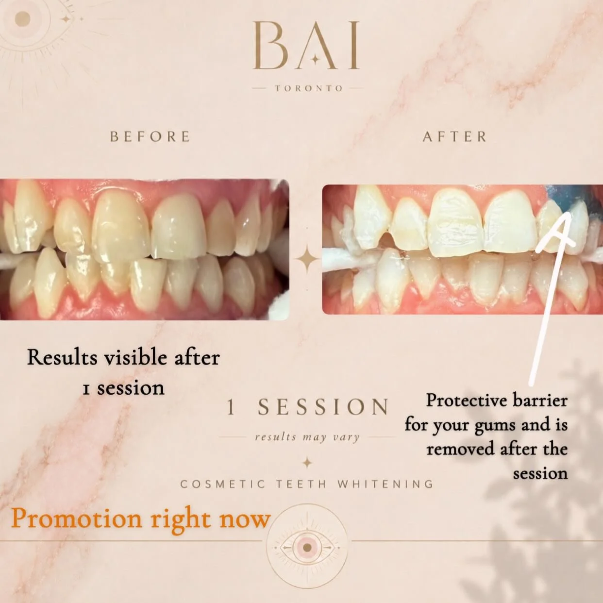 📍Etobicoke Toronto
✅Results guaranteed
😄Pain free minimal to zero sensitivity 
‼️Discount right now 

#Baitoronto #toothgem #teethwhitening #dentaltoronto #whitesmile