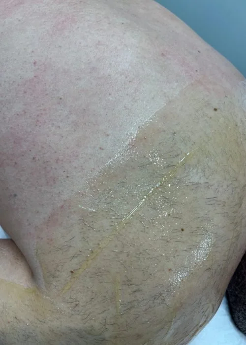 Close-up of a person's skin showing cracked and peeling dry skin, with some shiny areas indicating possible lotion or oil.
