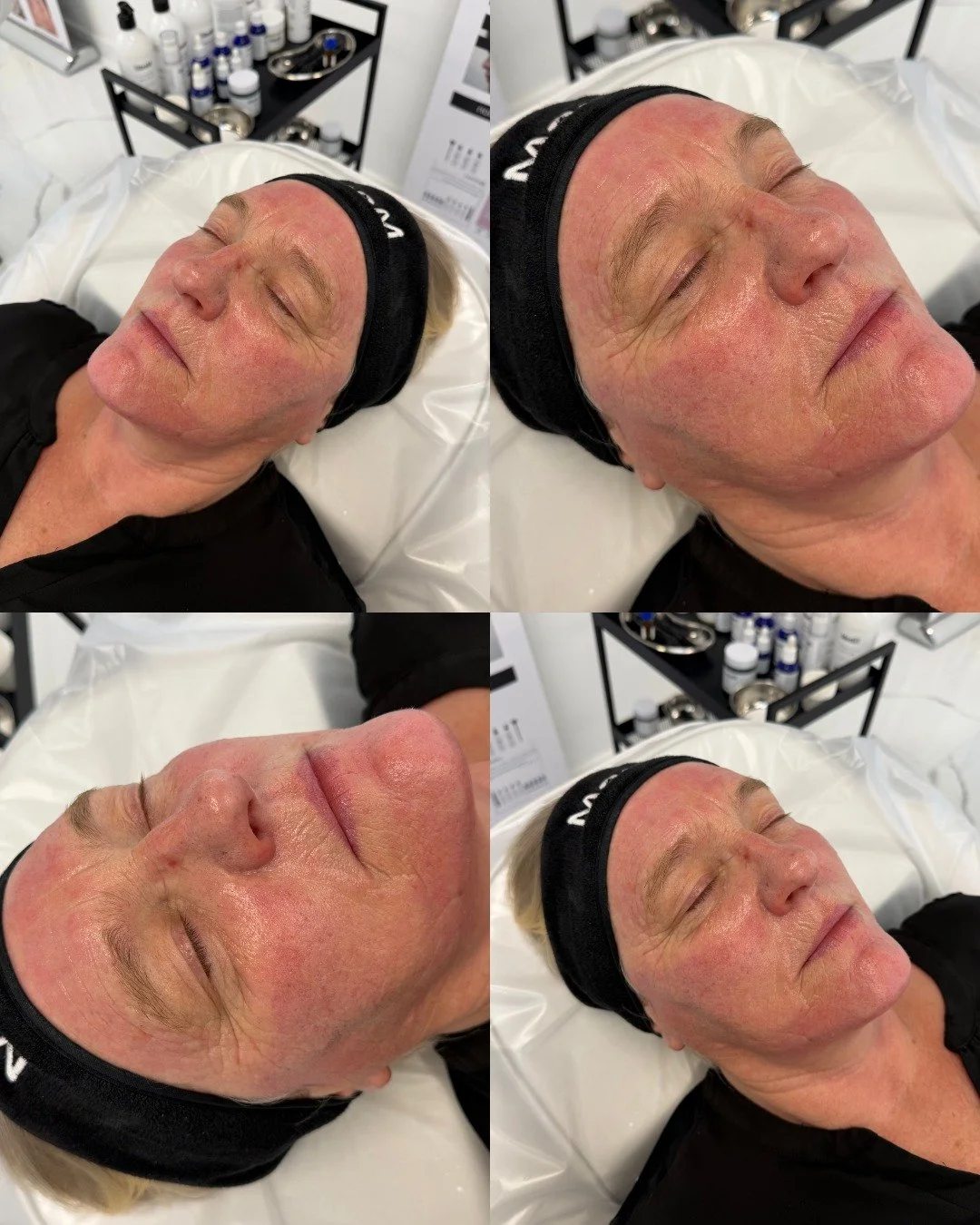 Medi MD Microneedling Before after.jpeg