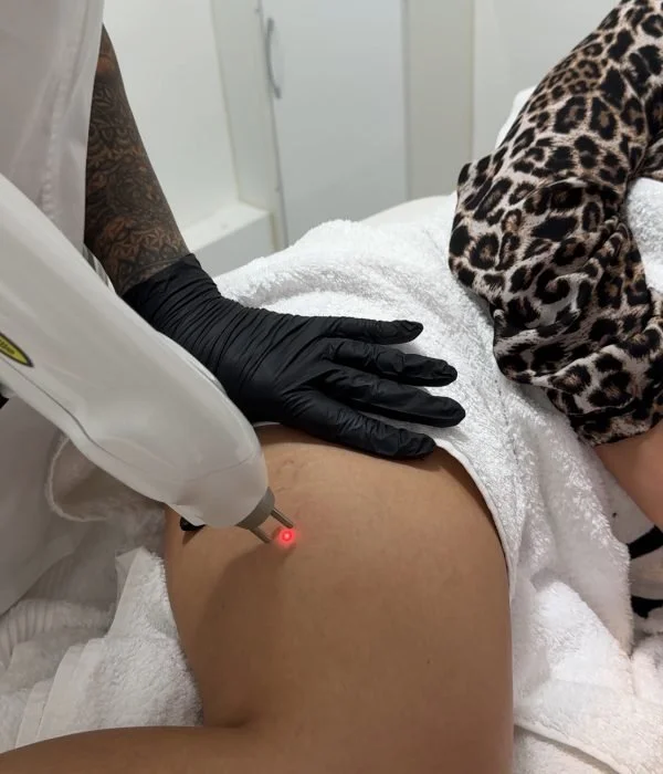 A cosmetic procedure being performed on a person's thigh with a laser device, in a clinical setting, with a person wearing black gloves and white clothing visible.