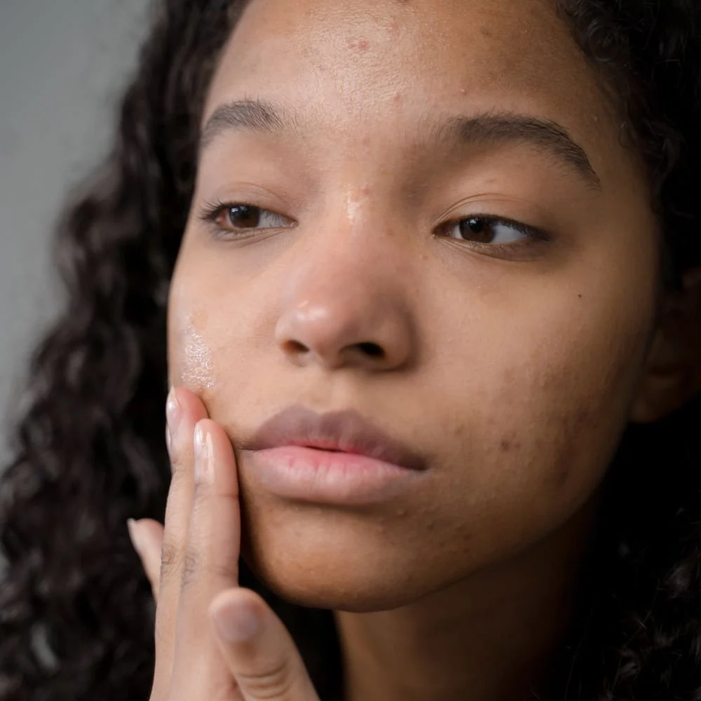 A young woman touching her face, focusing on her cheek which appears to have some blemishes or acne.