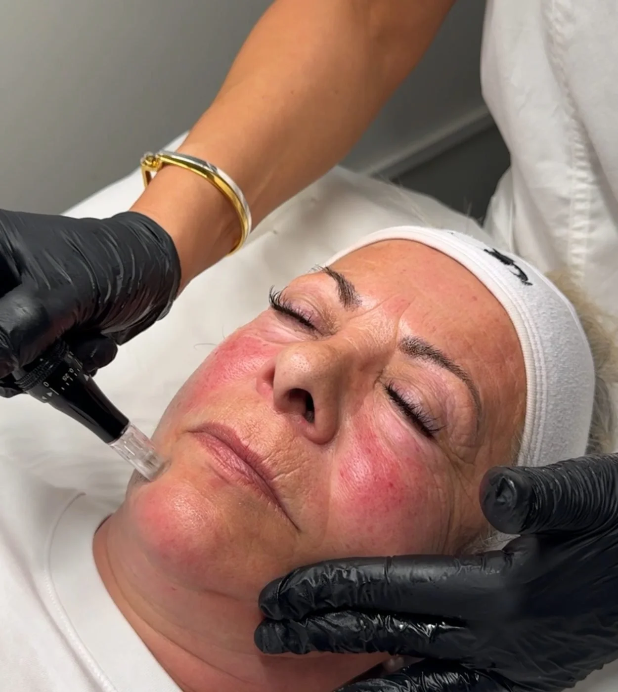 A woman receiving a facial treatment while lying down with her eyes closed. A skincare professional is using a small device on her cheek, and both are wearing black gloves.
