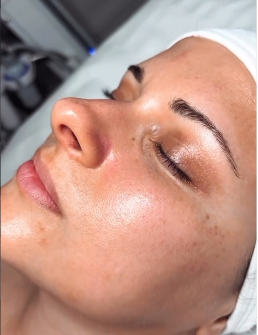 Close-up of a woman's face with clear skin, lying down with eyes closed, in a medical or skincare setting.