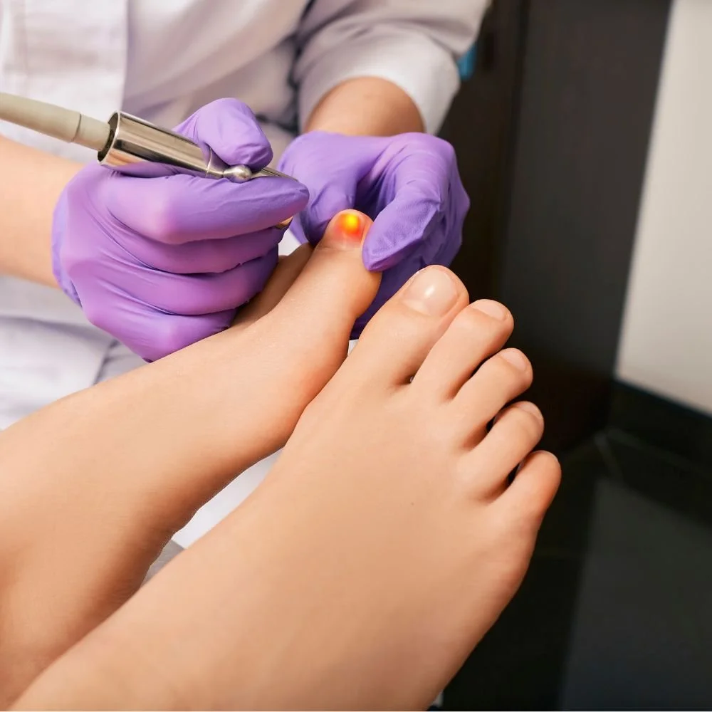 Podiatrist performing a laser treatment on a patient's toenail, wearing purple gloves.