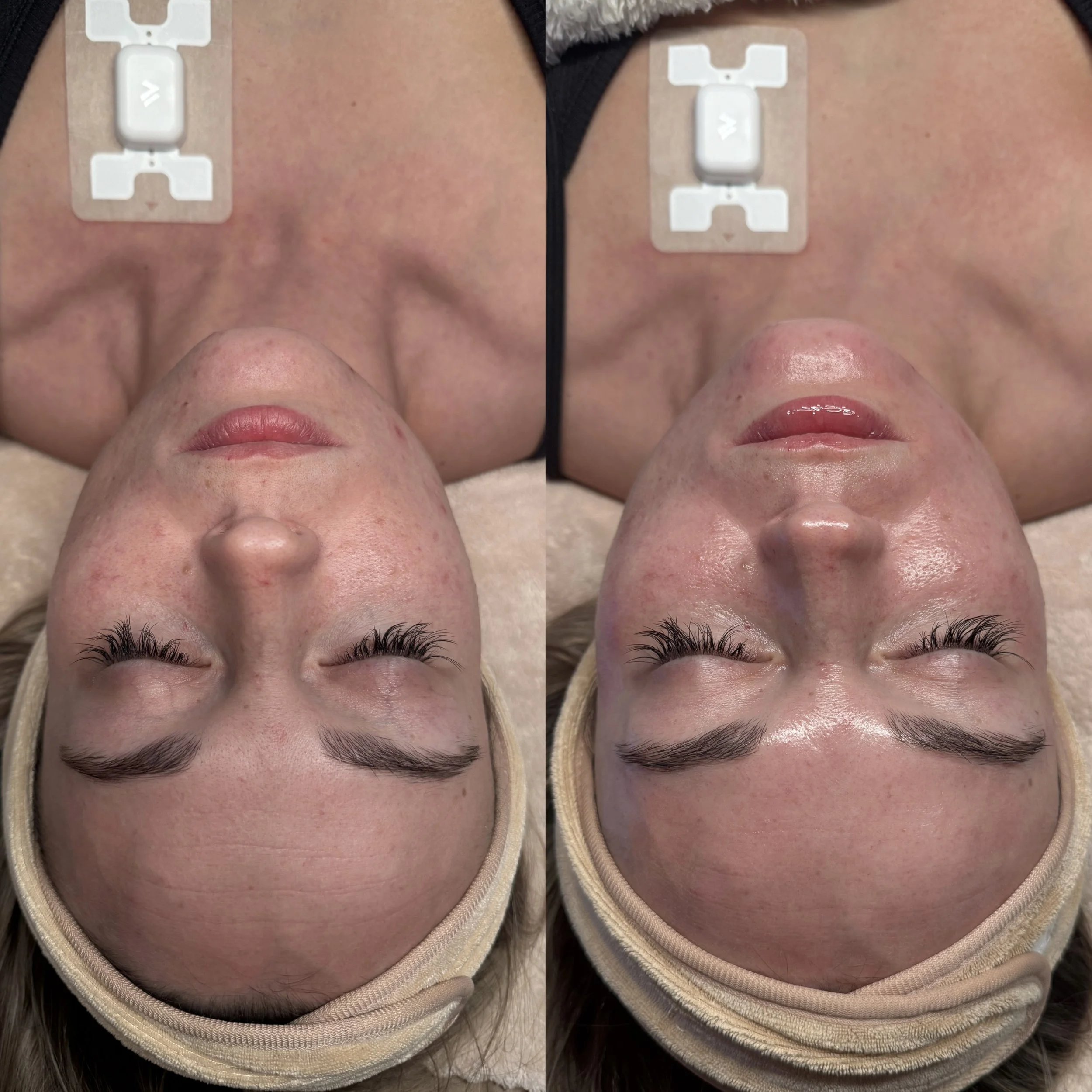 Hydrafacial before and after. Dermaplaning facial. Glens falls facial.