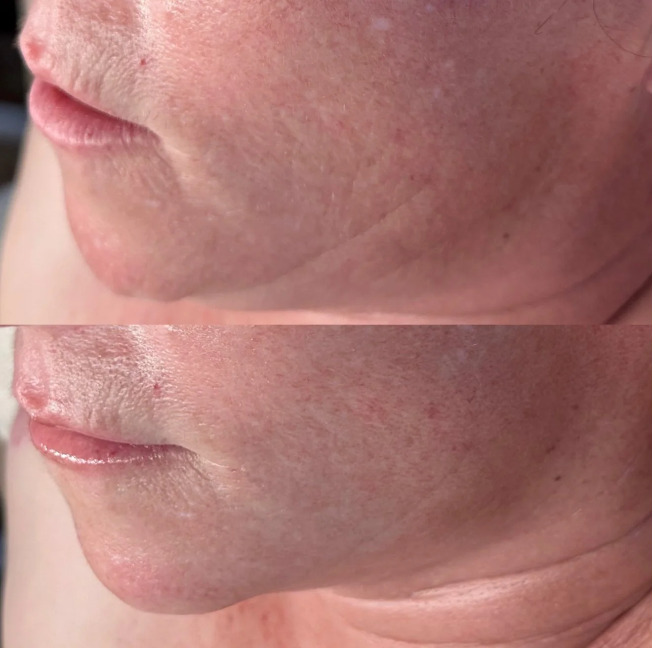 Close-up comparison of skin on a person's face, showing improved skin texture and redness reduction in the bottom image compared to the top image.