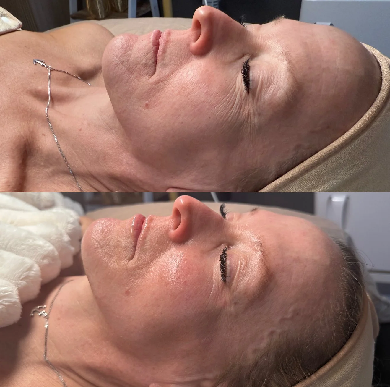 Before and after images of a woman lying down, showing the improvement in her skin and overall facial appearance following a treatment, with her eyes closed.