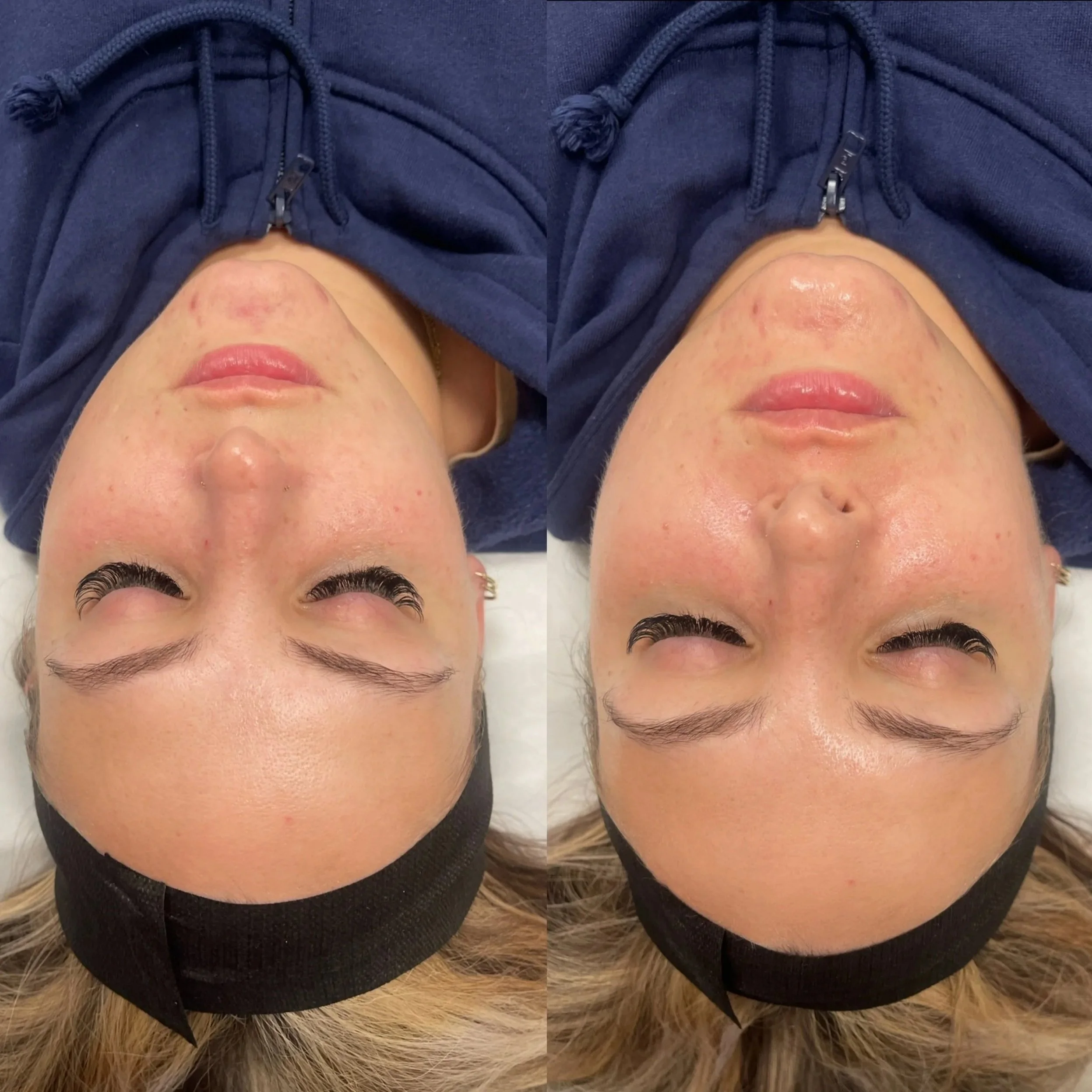 Close-up of a woman wearing a navy blue hoodie with a zipper, lying on a furry surface. The image is split into two parts showing before and after skincare or treatment, highlighting clearer skin in the second part.