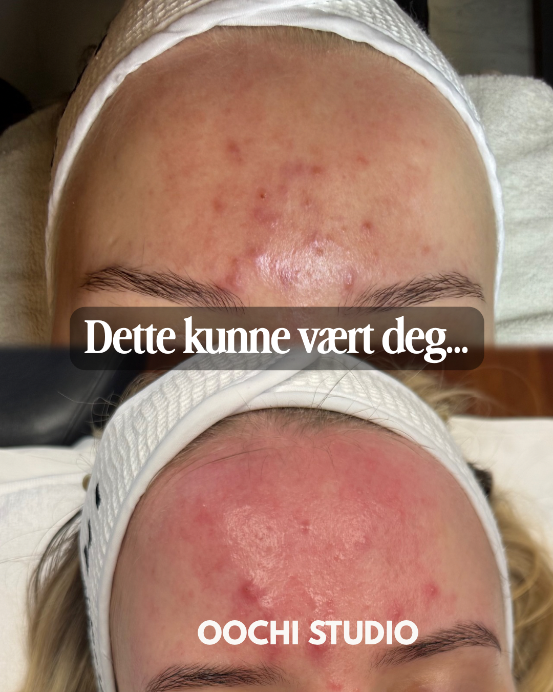Før og etter bilde av en persons panne med aknebehandling.