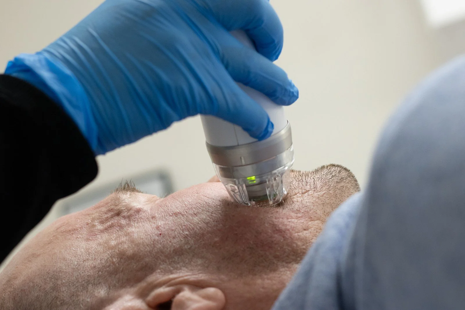 RF-Microneedling_0251.jpg