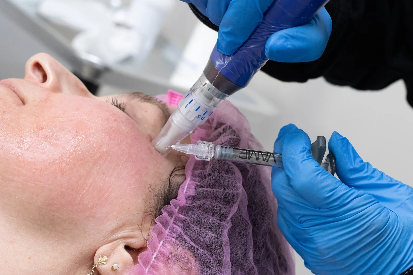The Science Behind Microneedling + Peptides – Why the Combination Supports Skin Remodeling