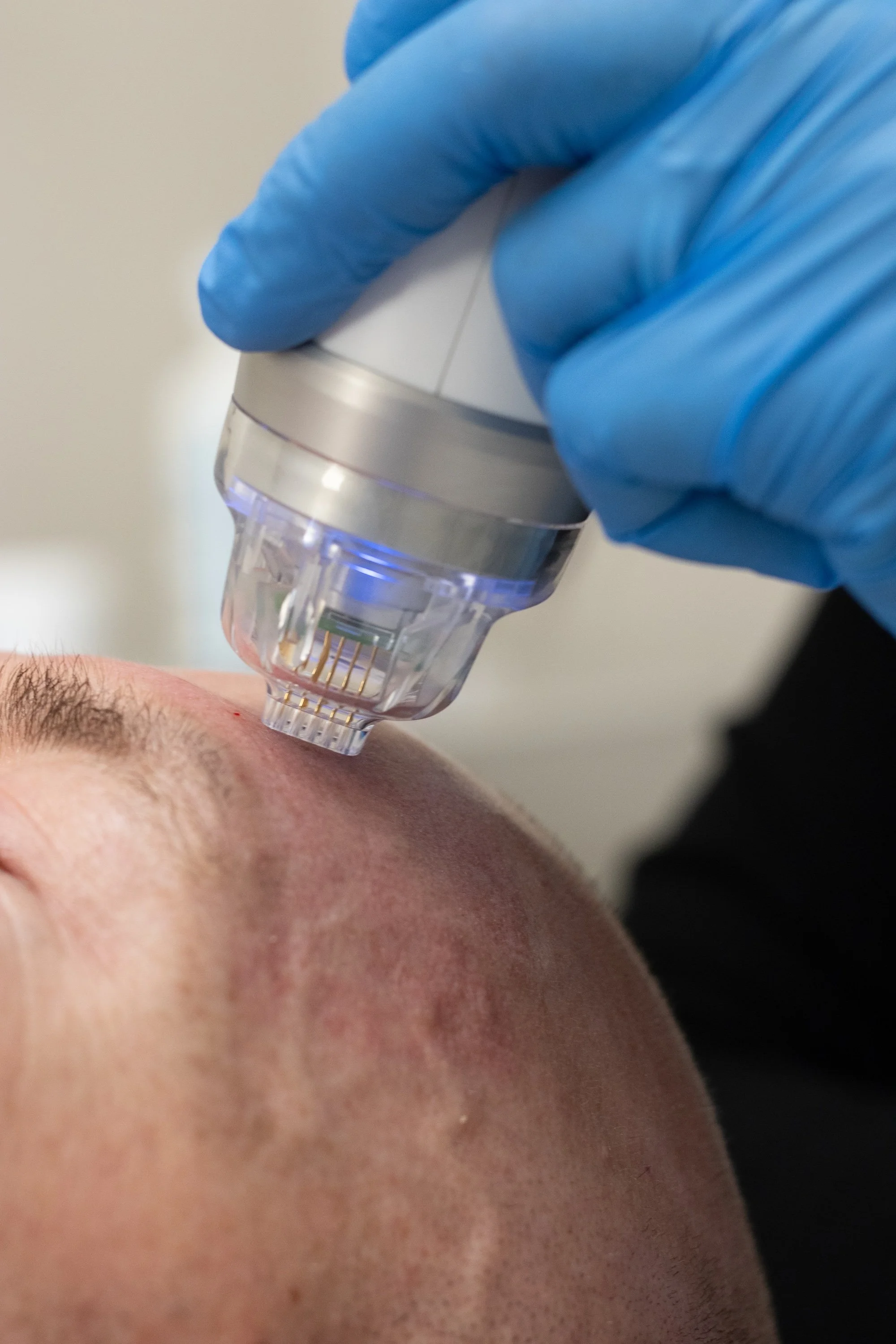 A close-up of a microneedling device moving across a man's forehead.