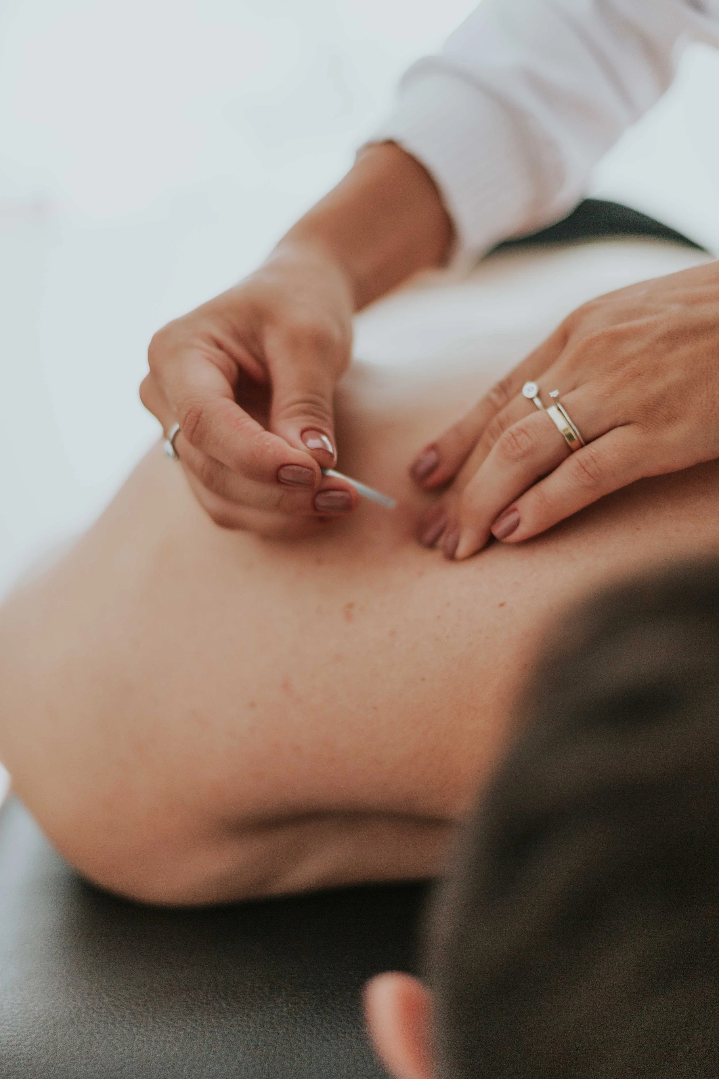Une personne effectue une acupuncture sur le ventre d'une autre personne, en insérant une aiguille fine.