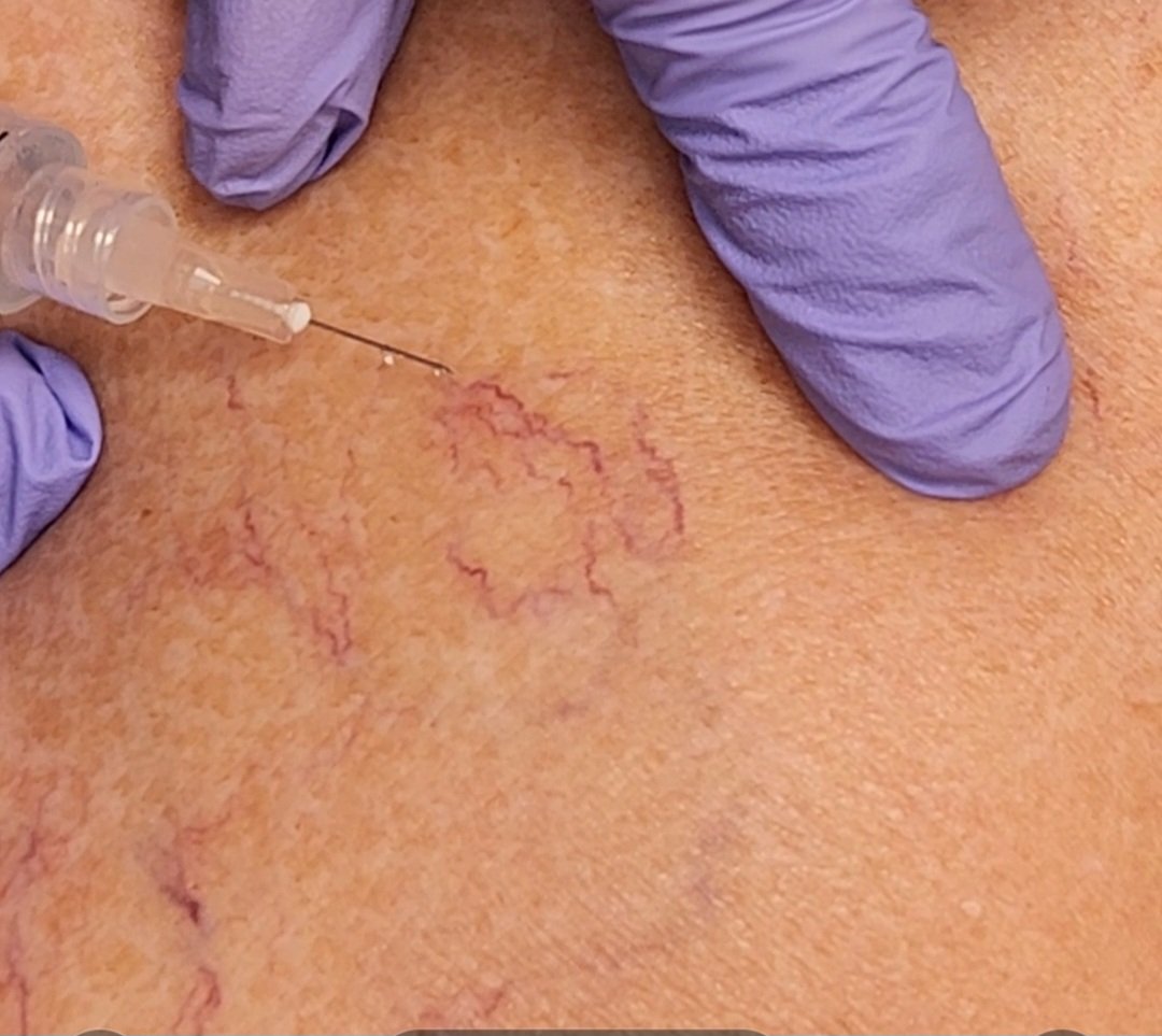 A close-up of skin with visible spider veins, with a medical professional wearing purple gloves administering an injection or treatment to the veins.