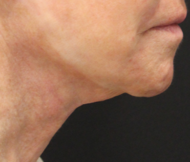 Close-up of a person's lower face and neck showing sagging skin and wrinkles.